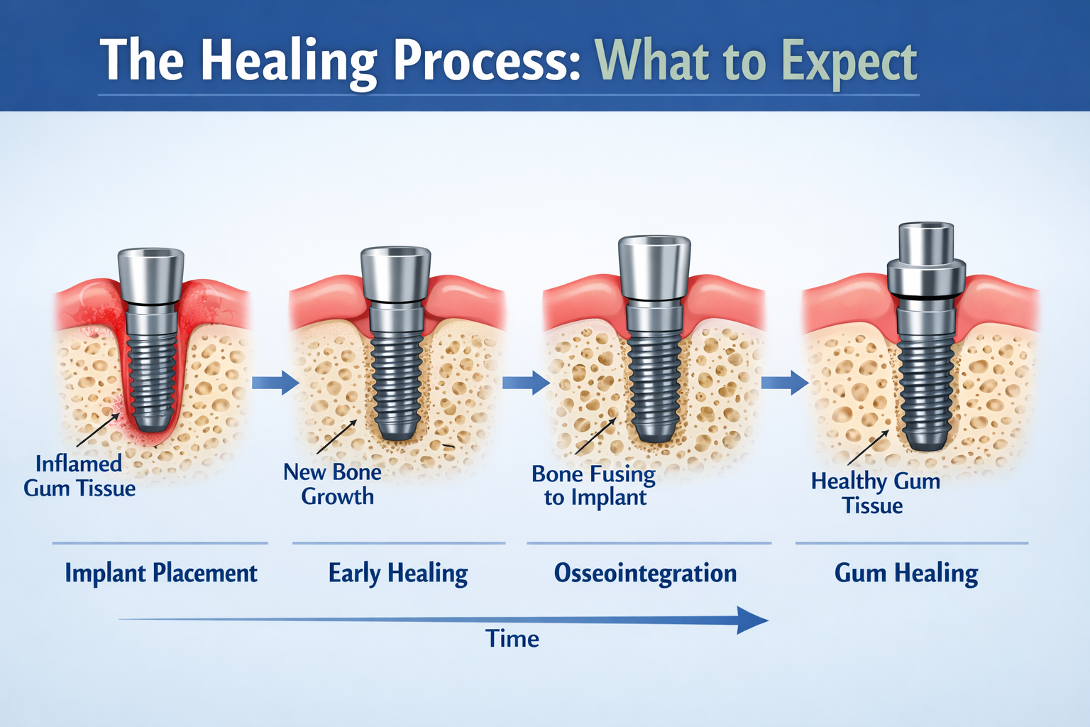 Is It Normal to Feel My Dental Implant with My Tongue? | Dallas Guide