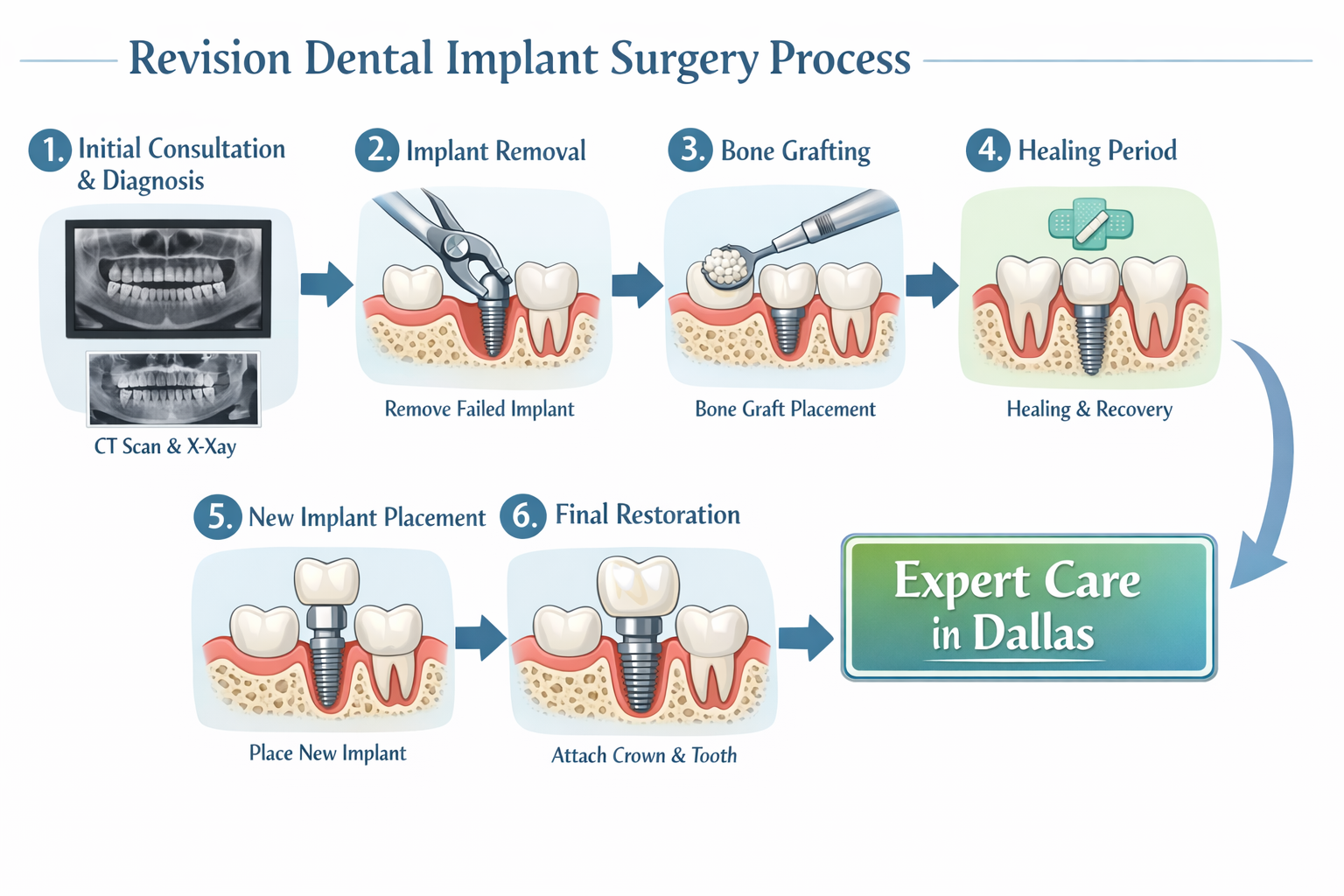 Revision Dental Implant Surgery Dallas: Restoring Your Smile and Confidence in 2026
