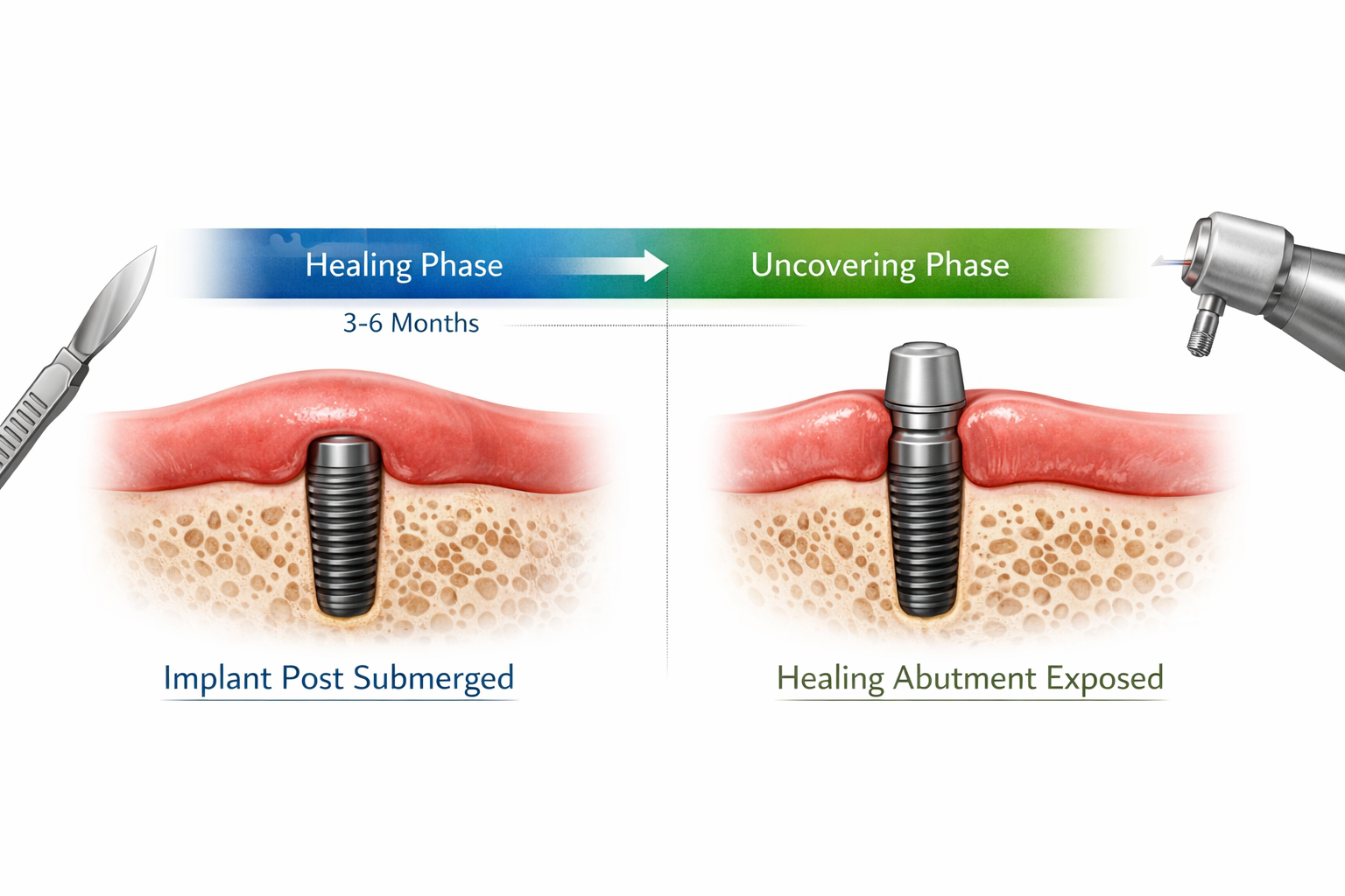 Dental Implant Uncovering Procedure: Your Comprehensive 2026 Guide