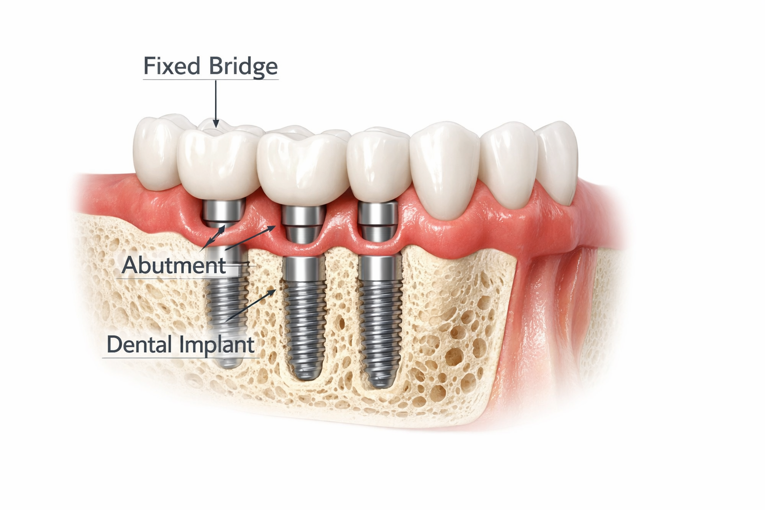 Fixed Bridge Dental Implants: Your Comprehensive 2026 Guide to a Lasting Smile in Dallas, TX
