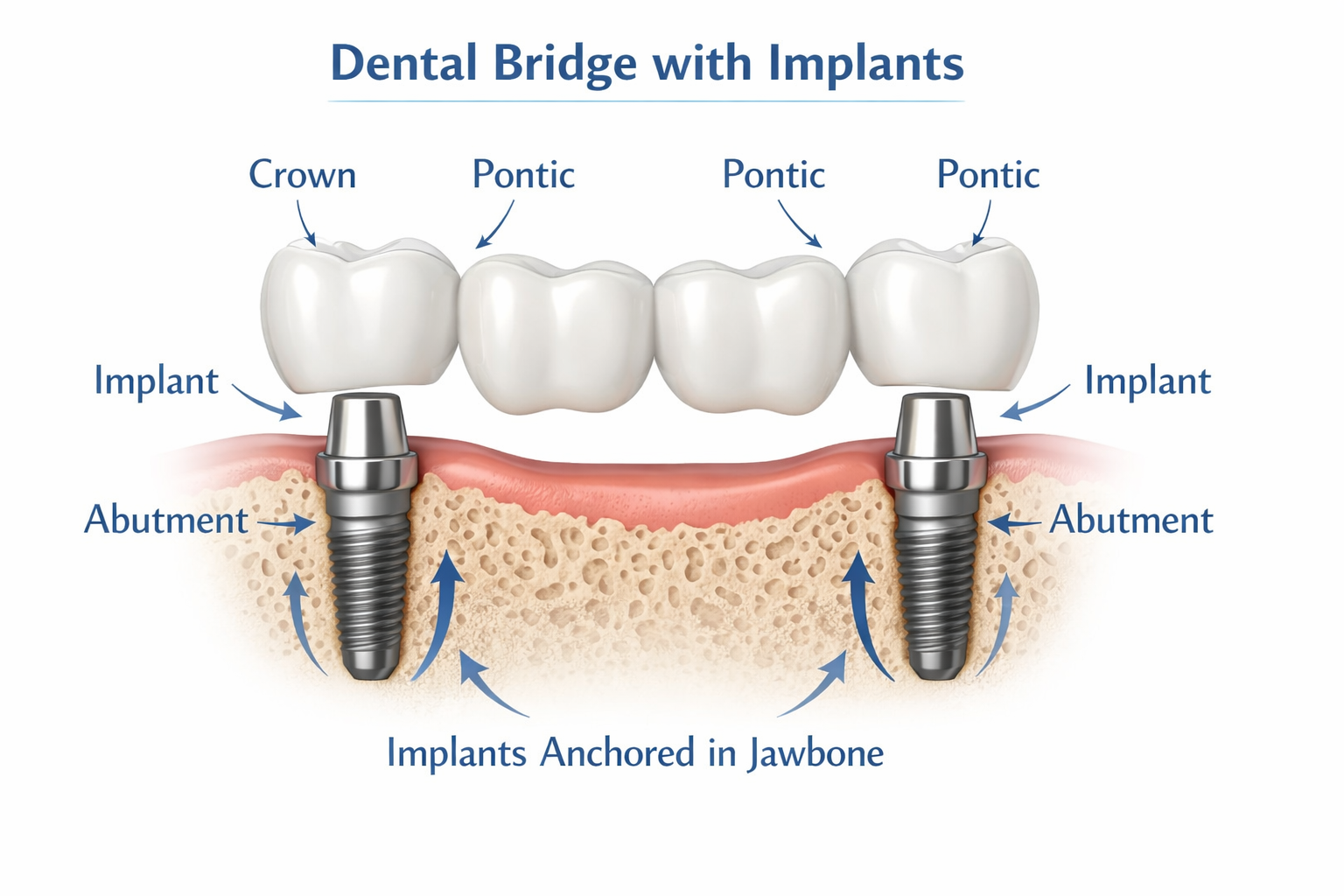 Dental Bridge with Implants
