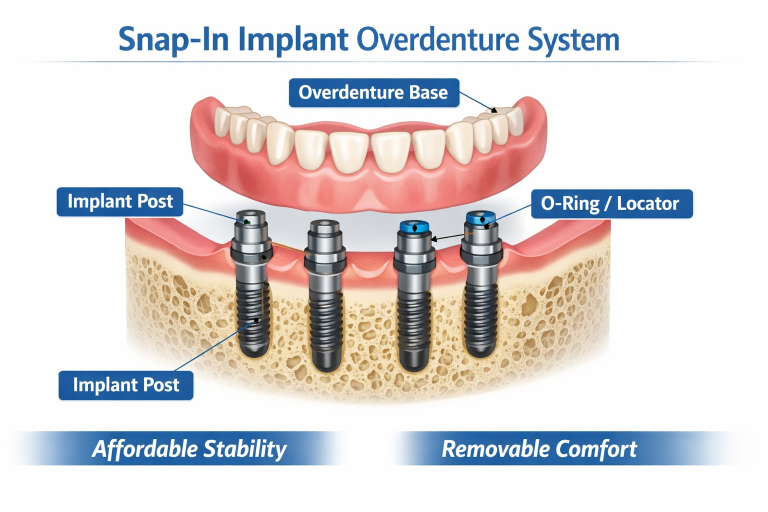 A detailed infographic in landscape format (1536x1024) illustrating the components of a snap-in implant overdenture system. Show a cross-sec