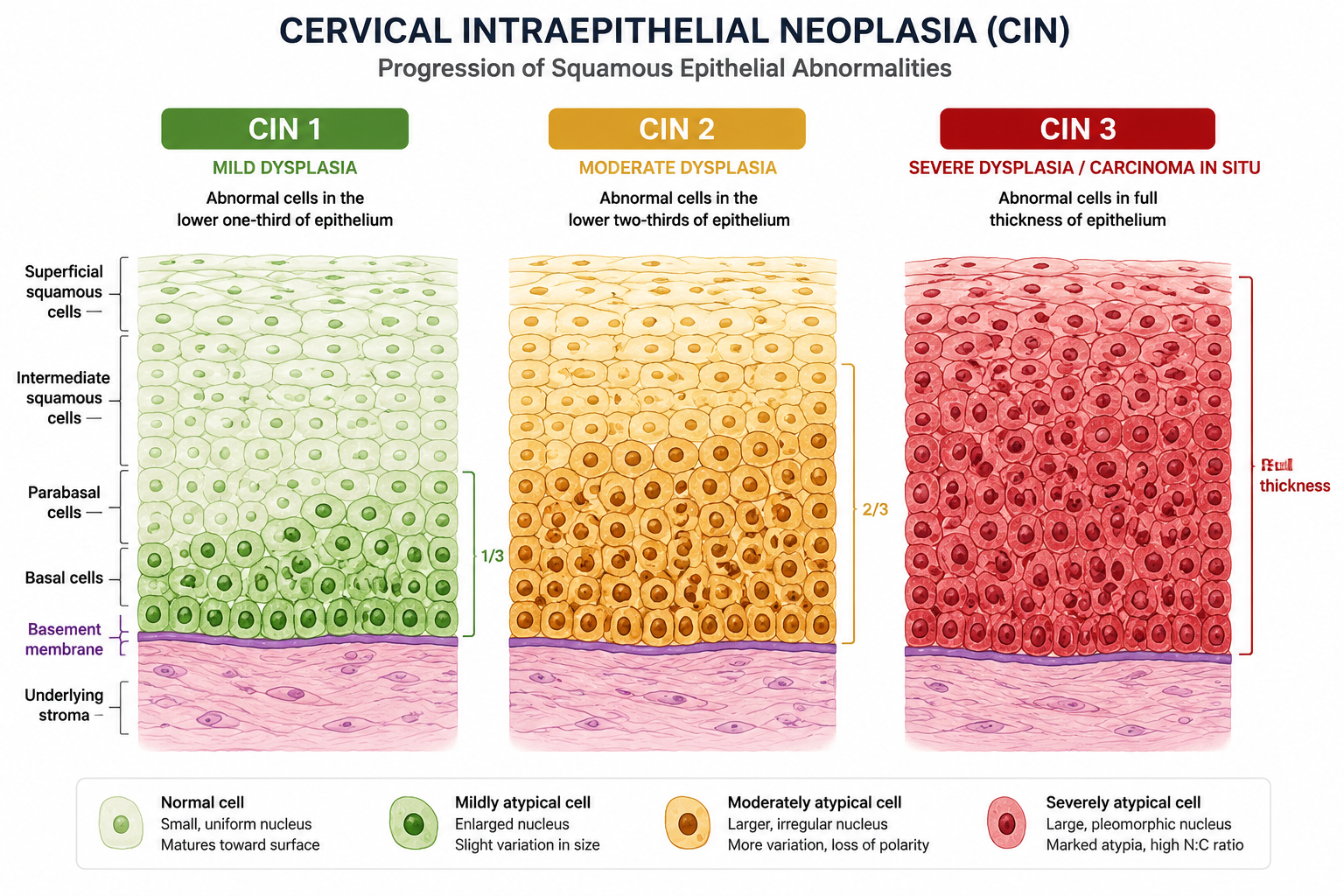 Detailed () medical cross-section diagram of cervical epithelium showing three side-by-side columns labeled CIN 1, CIN 2,
