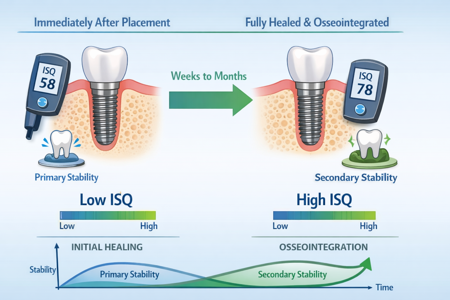 What is Implant Stability Quotient (ISQ)? Your 2026 Guide to Dental Implant Success