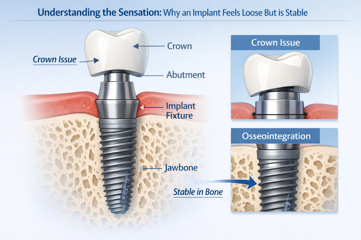 Implant Feels Loose But Stable: Causes & Fixes in Dallas 2026