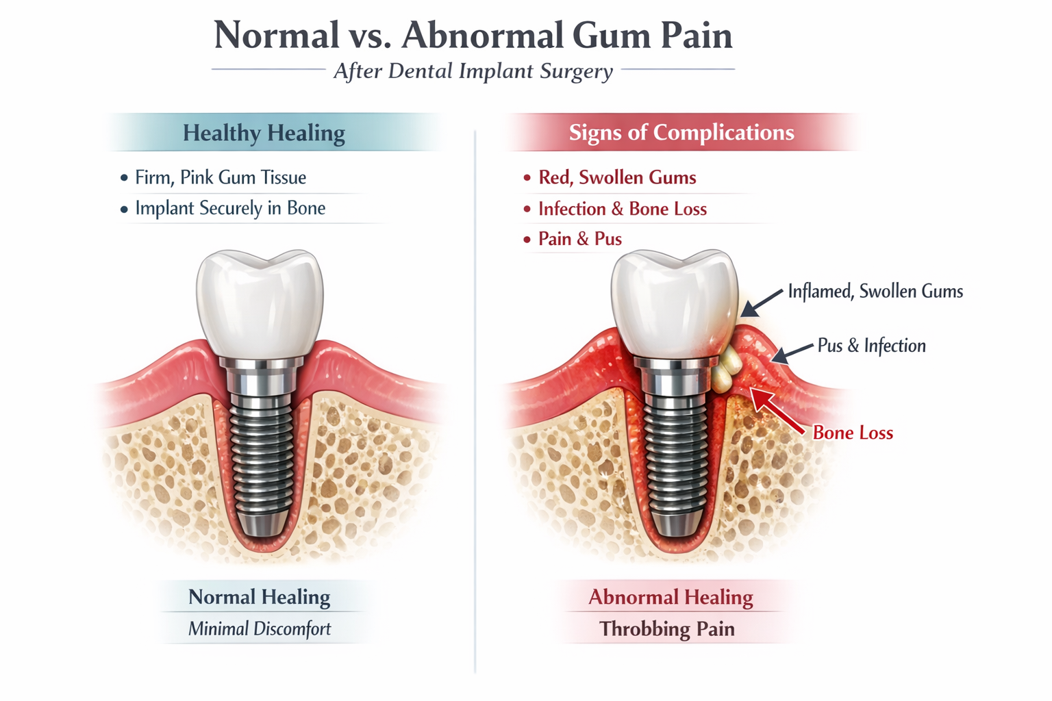 Dental Implant Gum Pain – Is It Normal?