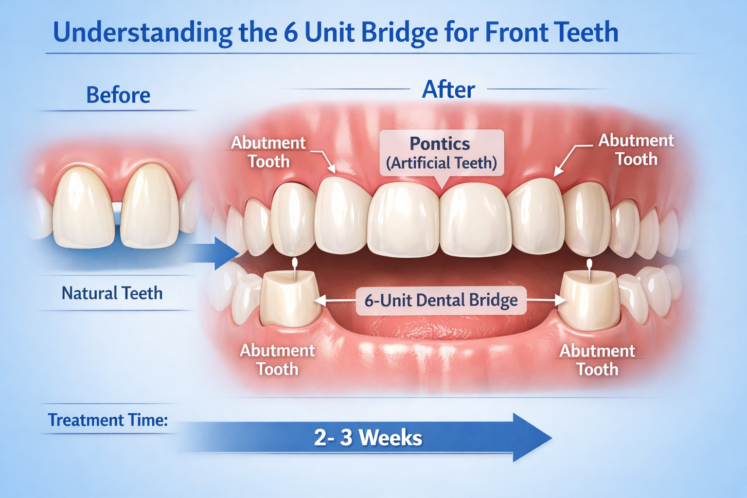 Navigating 6 Unit Bridge Front Teeth: A Comprehensive Guide for 2026