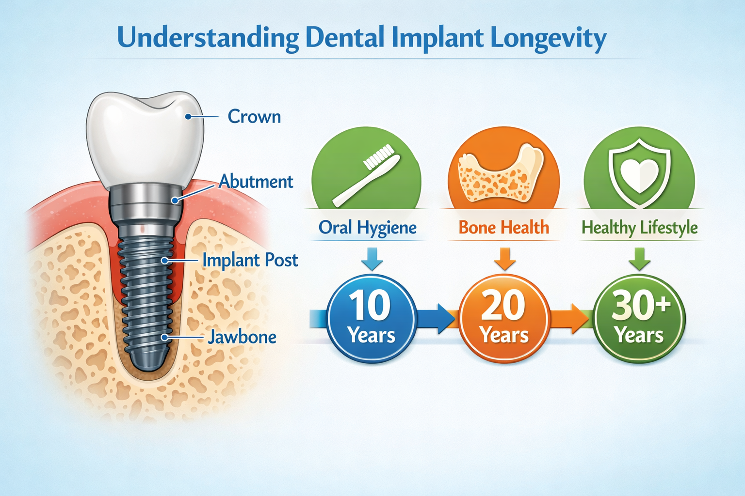 Detailed () image for the 'Understanding Dental Implant Longevity' section, featuring a clear, illustrative diagram of a