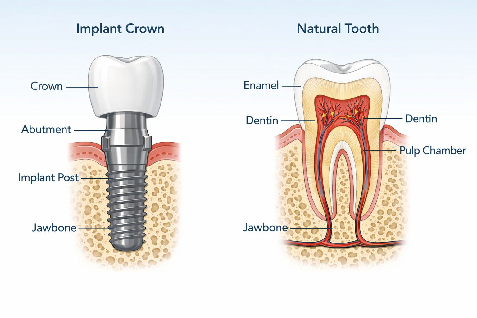 Implant crown vs natural tooth care