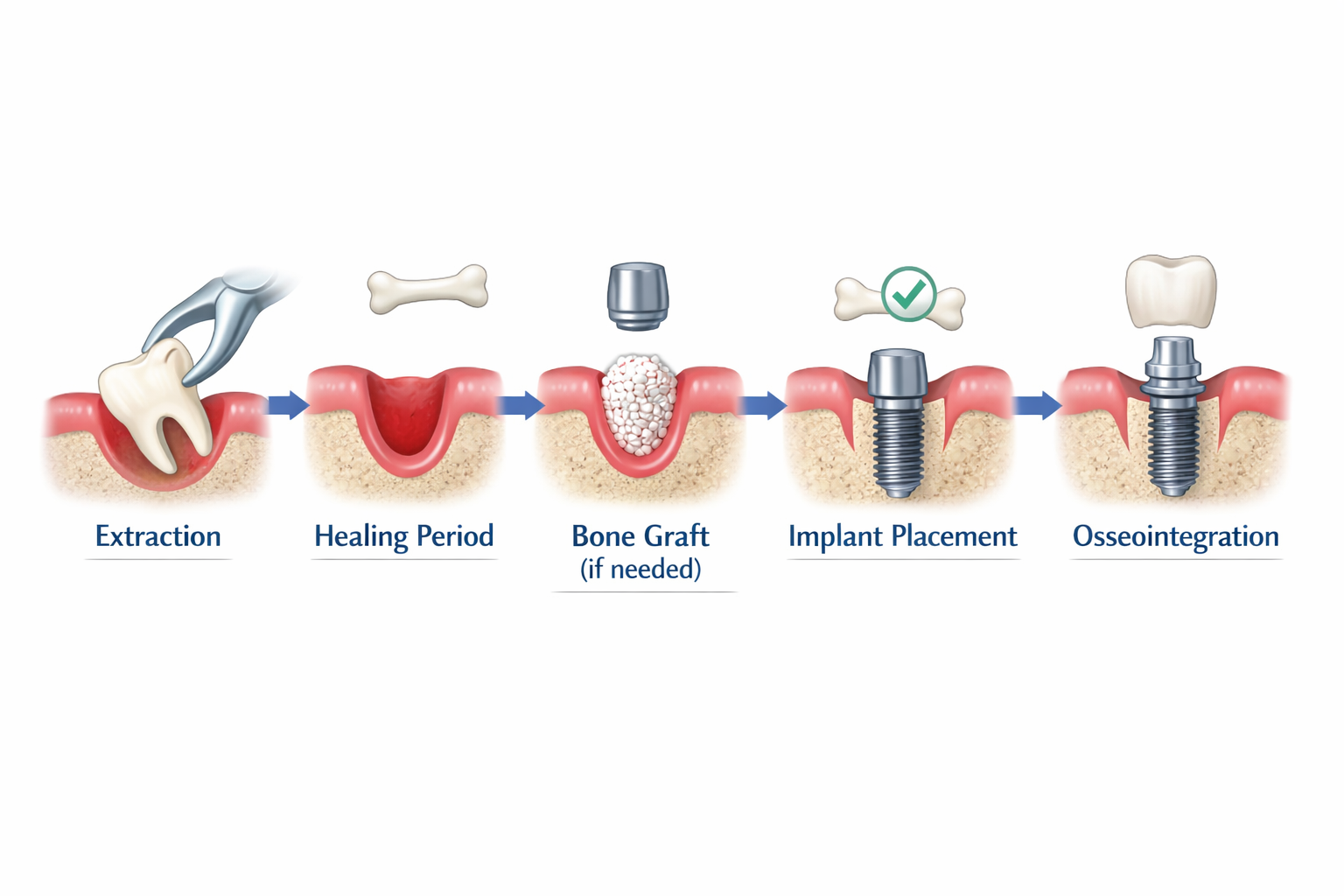 How long after tooth extraction can I get a dental implant