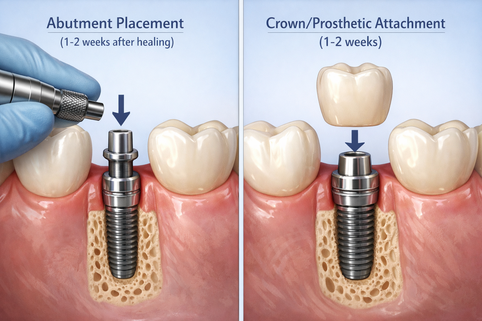 How Long Does Dental Implant Process Take? Your Complete 2026 Guide