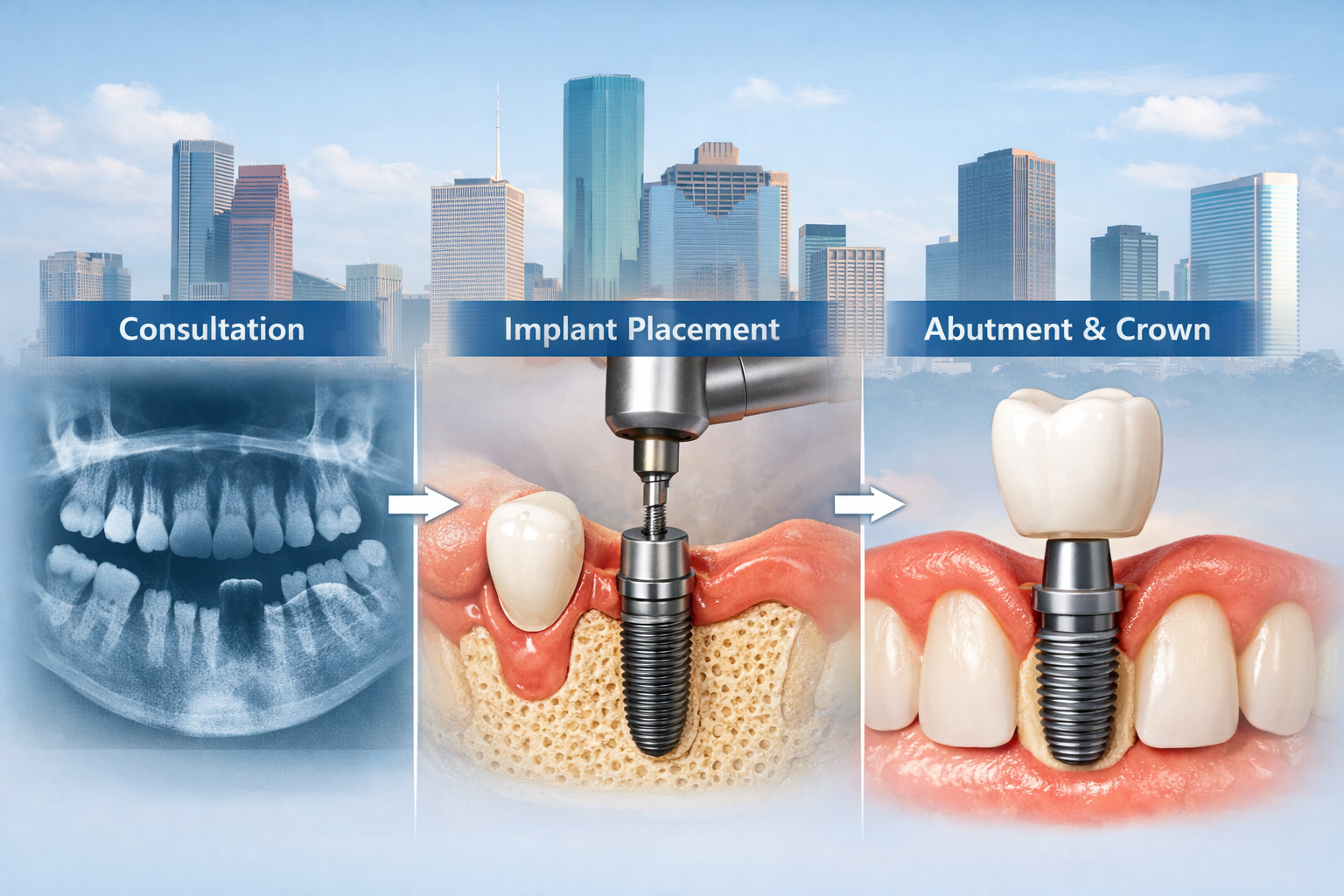 Dental Implants Houston