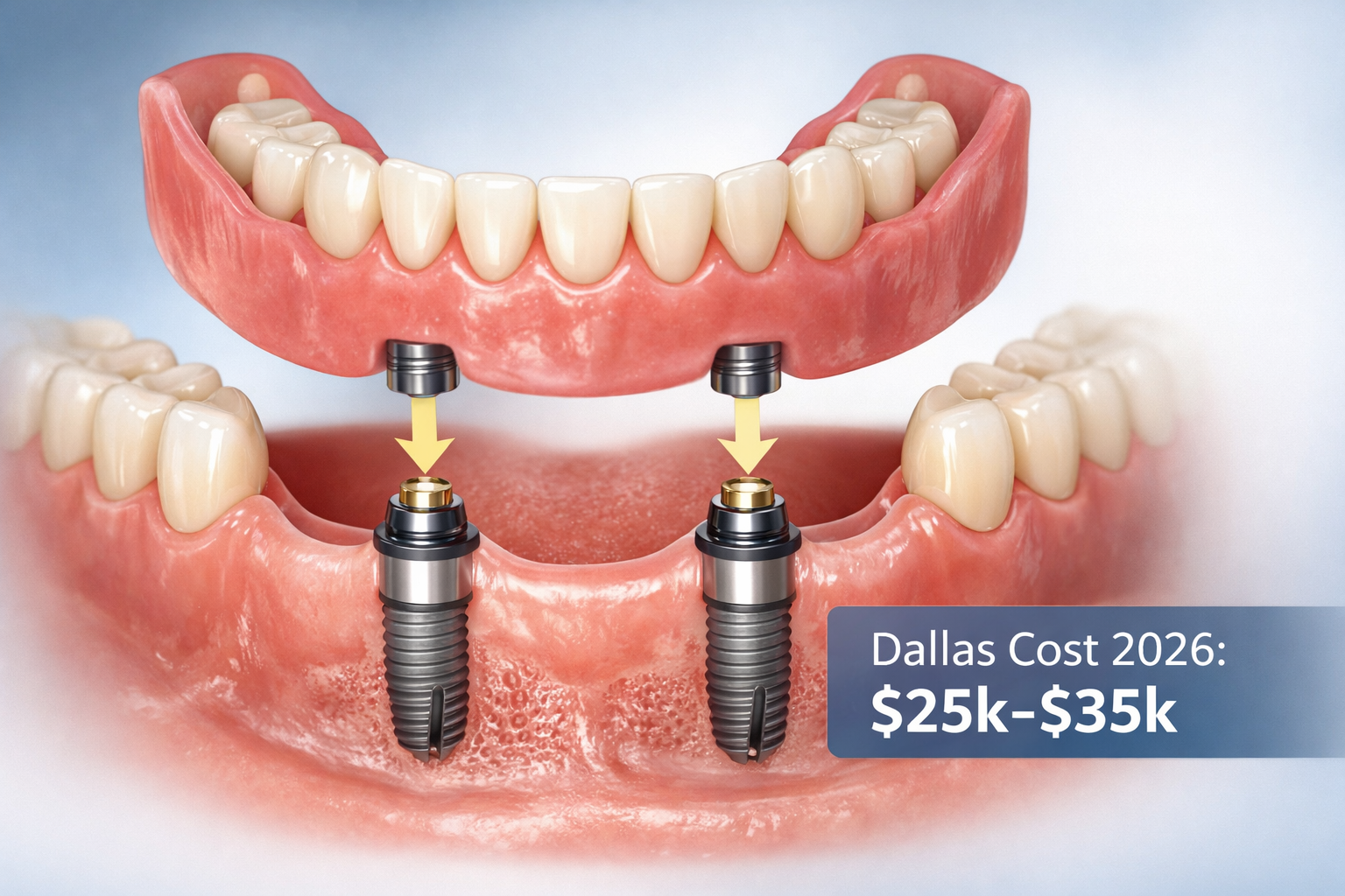 Landscape format (1536x1024) image illustrating the concept of snap-in denture implants with a clear visual of a lower arch denture snapping