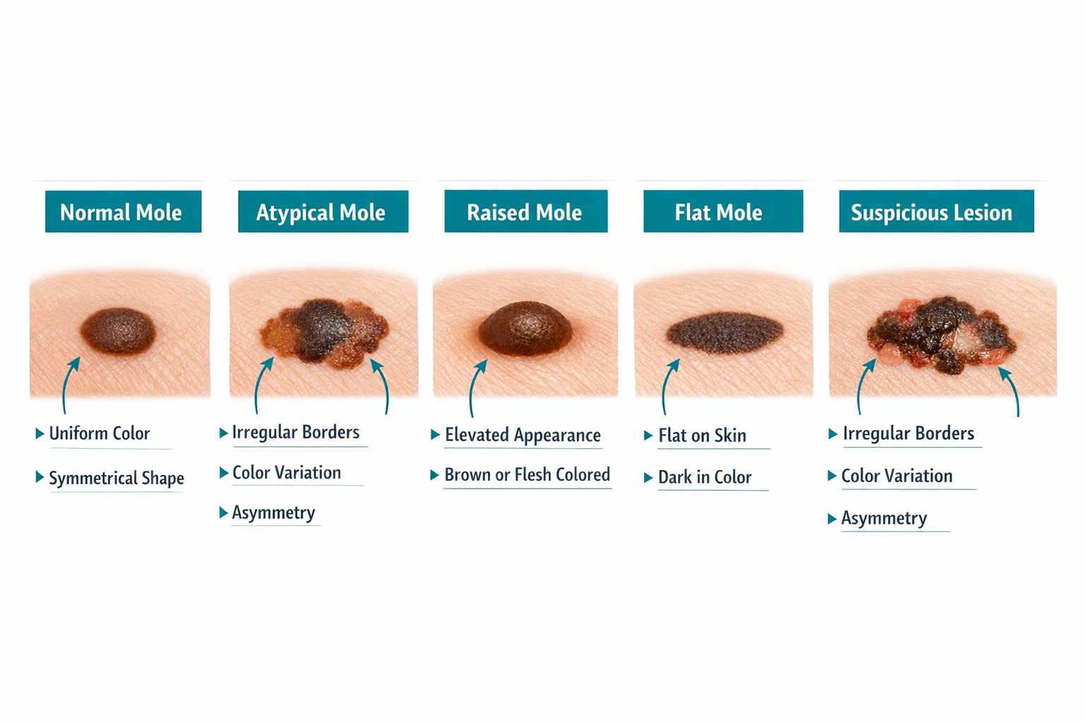 () informational illustration showing a side-by-side visual comparison of five mole types: normal benign mole, atypical