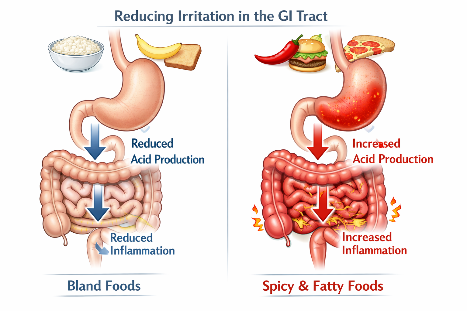 A digestive system diagram showing how bland foods reduce irritation in the GI tract compared to spicy/fatty foods, with