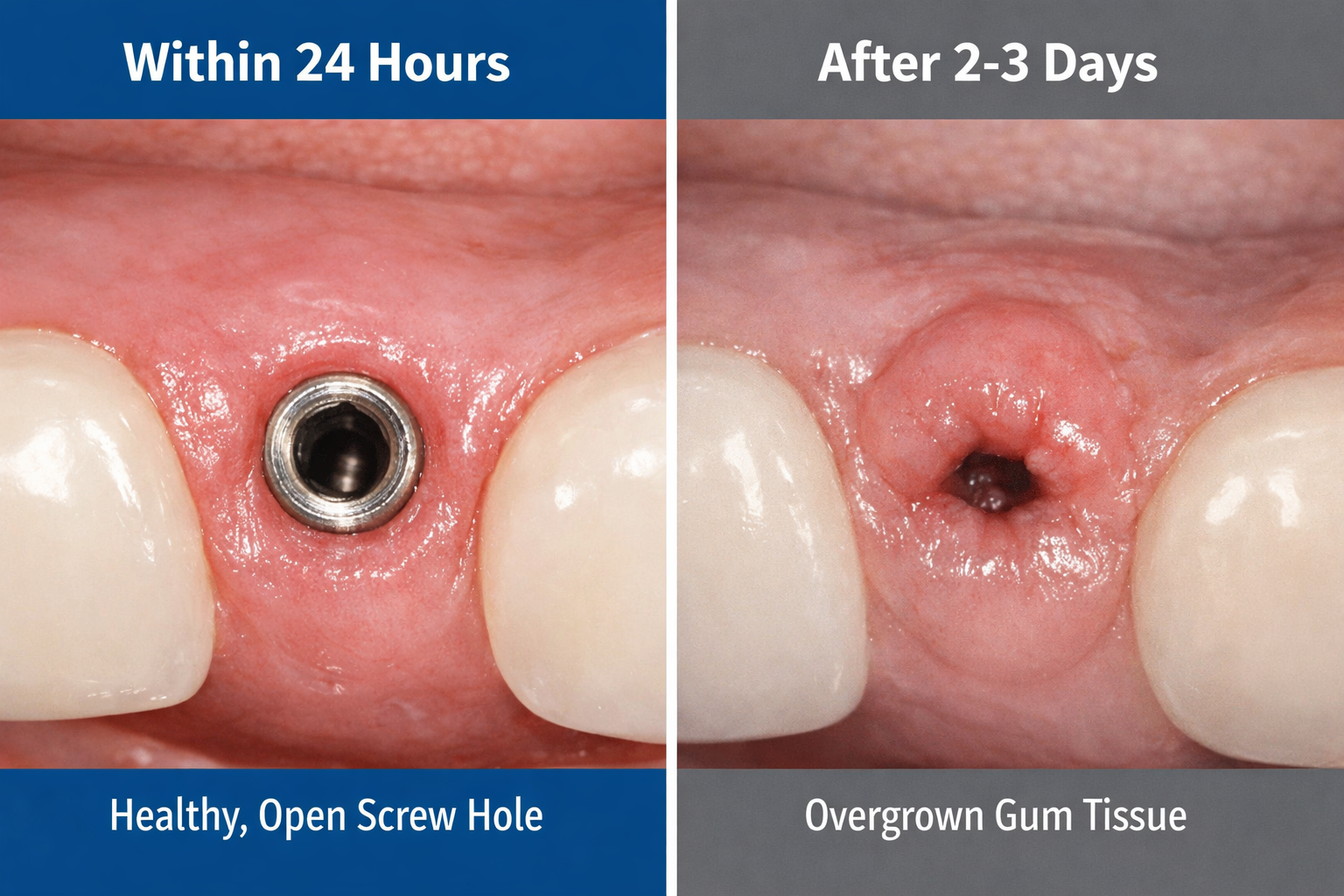 Dental Implant Healing Cap Fell Out? What to Do Now