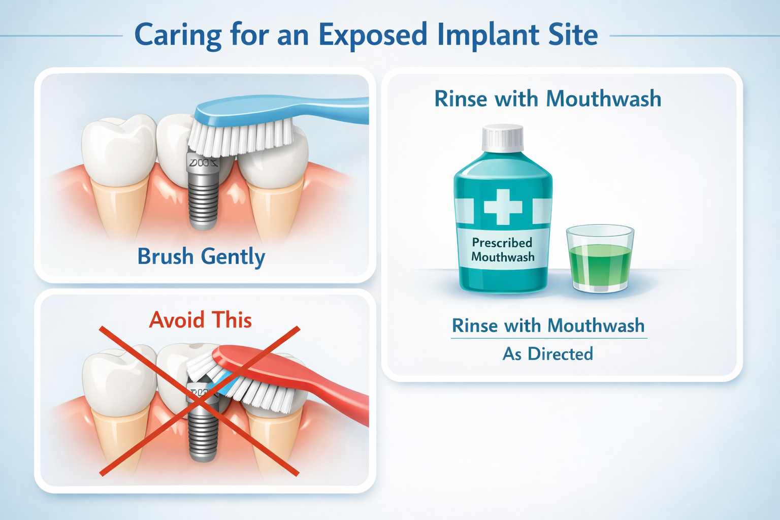 Dental Implant Healing Cap Fell Out? What to Do Now