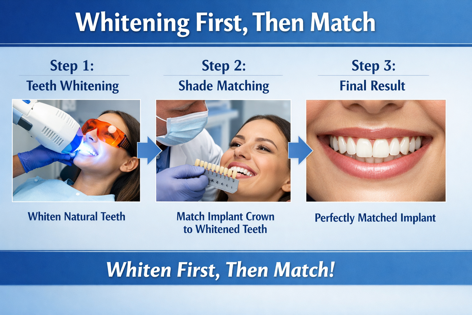 Can you whiten dental implant crowns or do they stain