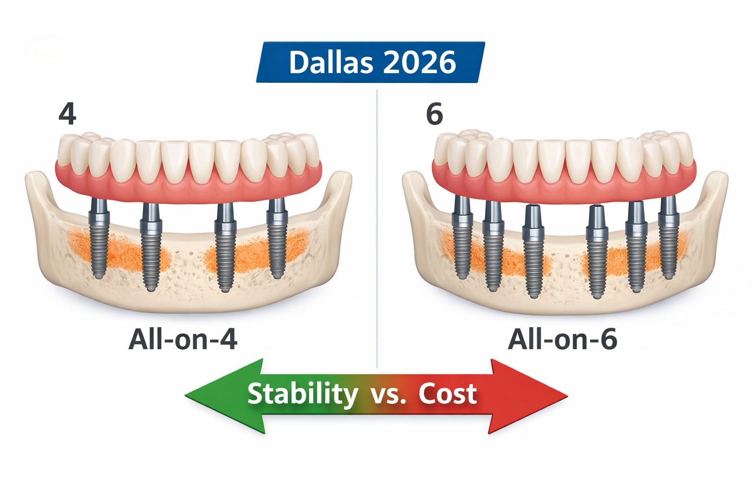 Landscape format (1536x1024) image comparing All-on-4 and All-on-6 dental implant structures. On one side, a clear, simplified diagram of a