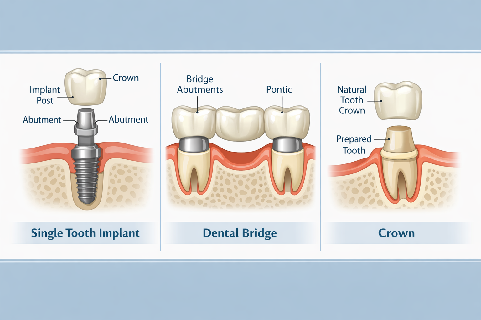 Landscape format (1536x1024) image presenting a clear infographic comparing the visual differences between a single tooth implant, a dental 