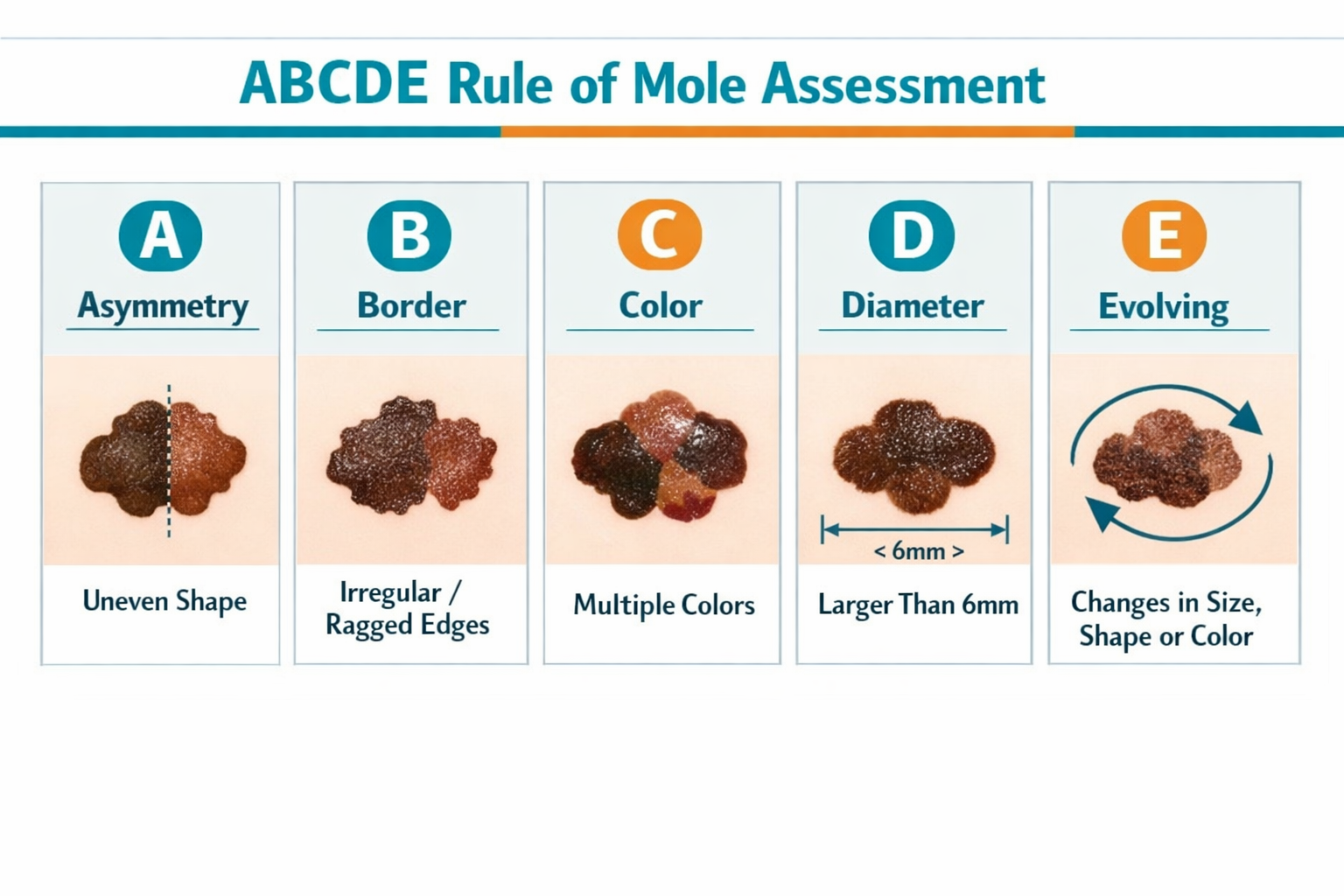 () editorial illustration showing the ABCDE rule for mole assessment: five side-by-side mole diagrams labeled A through E