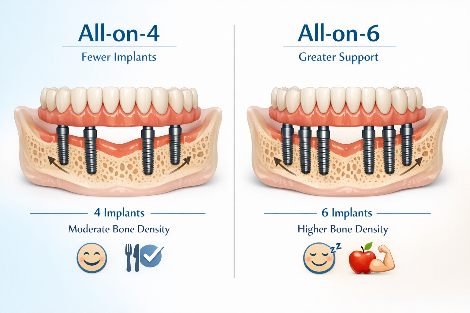 Comparing Full Mouth Dental Implant Options in Dallas: What to Know About All-on-4, All-on-6, and Zygomatic Implants