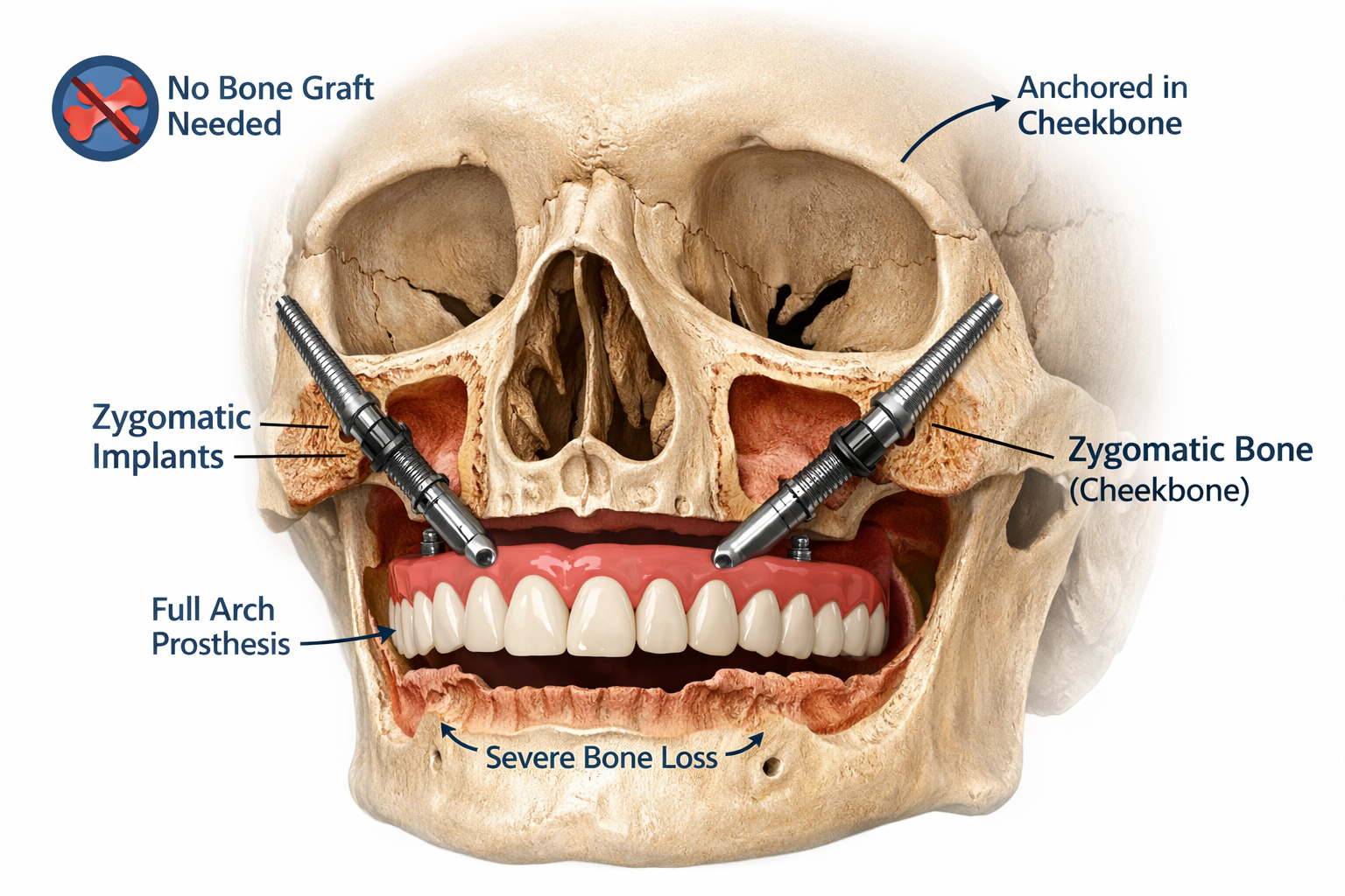 Comparing Full Mouth Dental Implant Options in Dallas: What to Know About All-on-4, All-on-6, and Zygomatic Implants