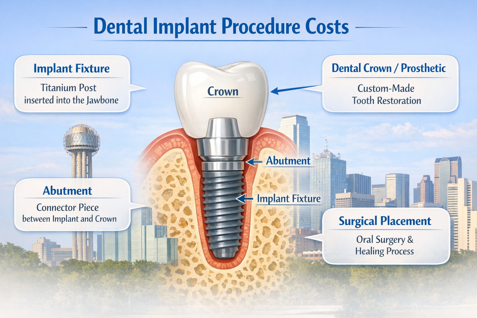 A visual representation in () detailing the components of the core dental implant procedure cost. This image should feature