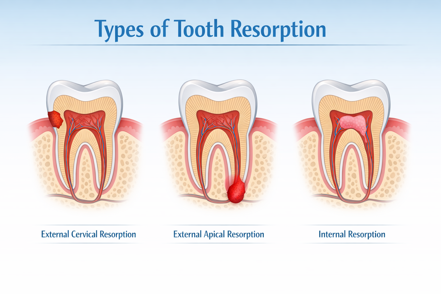 Tooth Resorption
