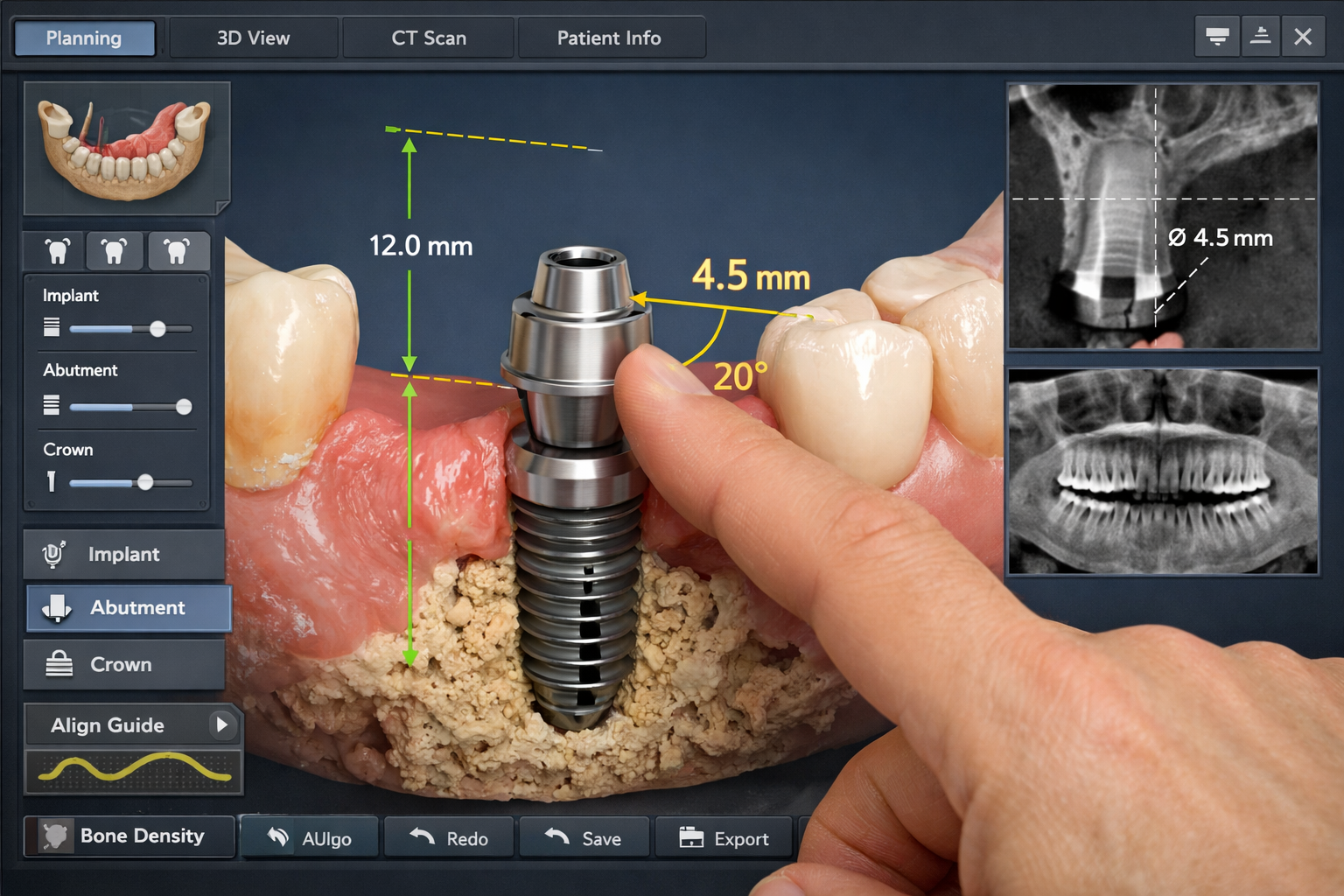 Can Dental Implant Crown Be Replaced Without Removing Post? | Dallas