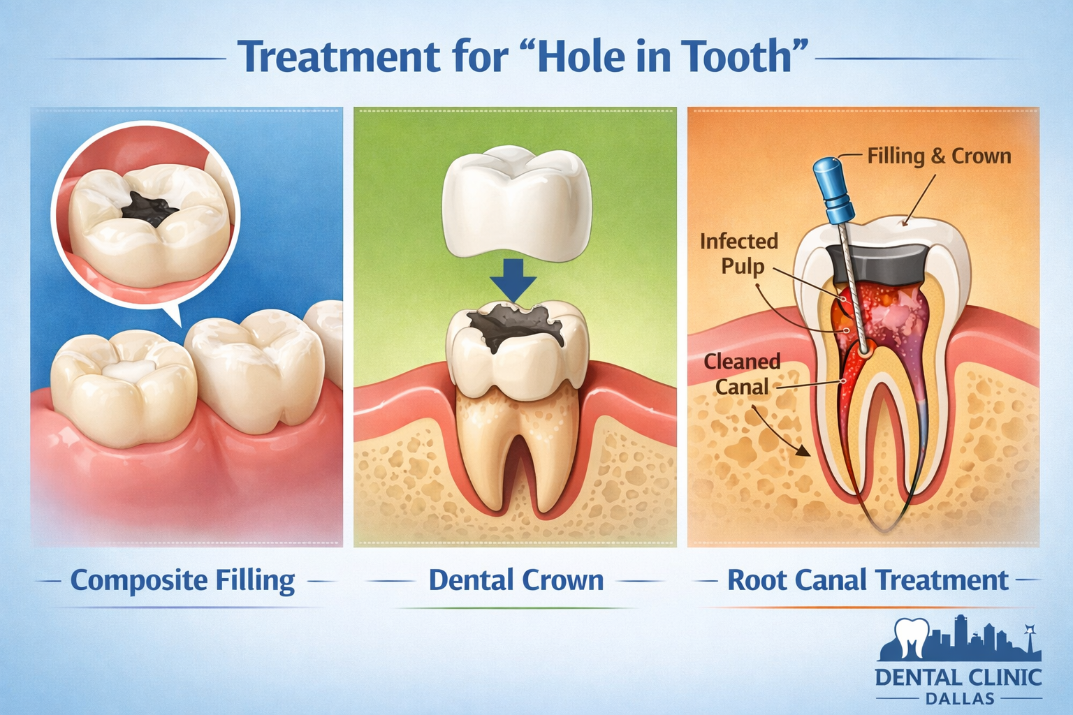 Hole in Tooth: Causes, Treatments & Prevention in Dallas 2026