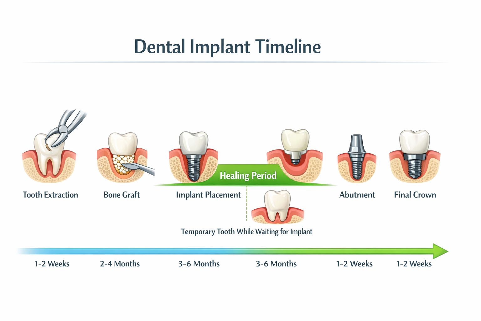 Navigating the Gap: Your Guide to a Temporary Tooth While Waiting for Implant