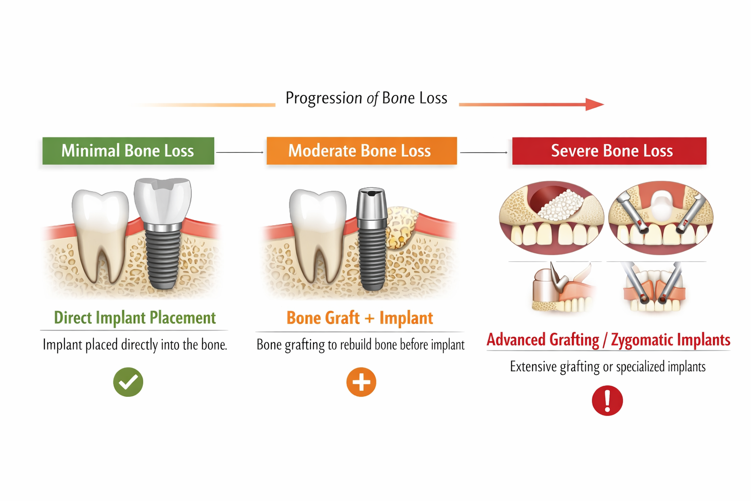 Bone Loss for Dental Implants: How Much is Too Much?