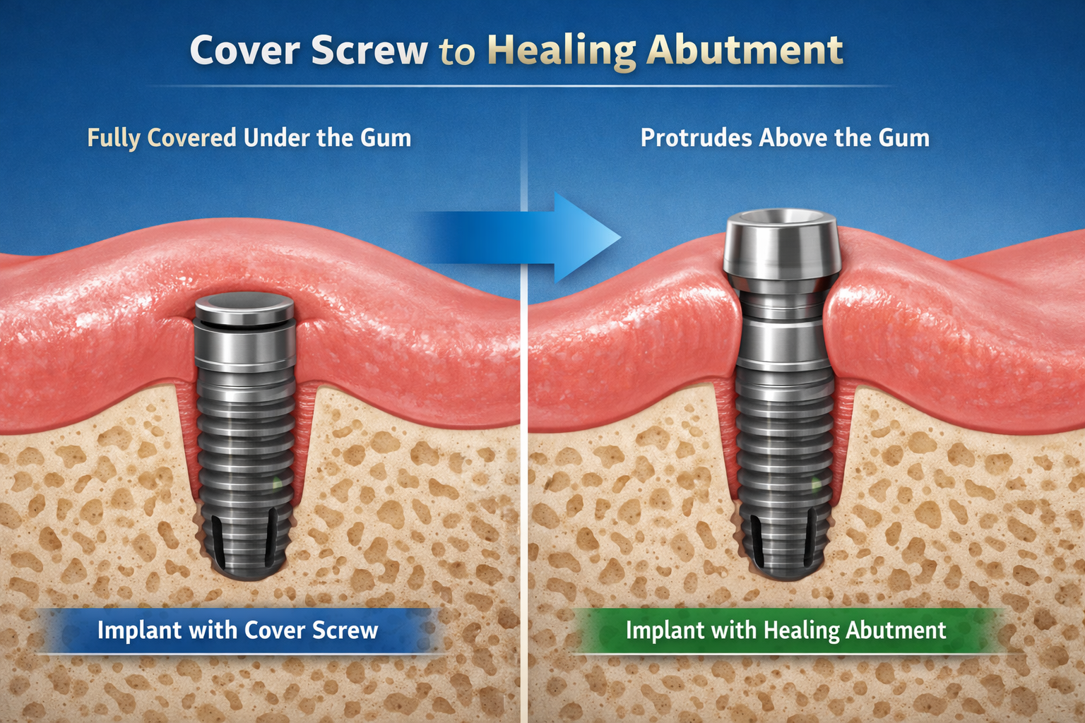 Healing Abutment vs Cover Screw: Navigating Your Dental Implant Journey in 2026