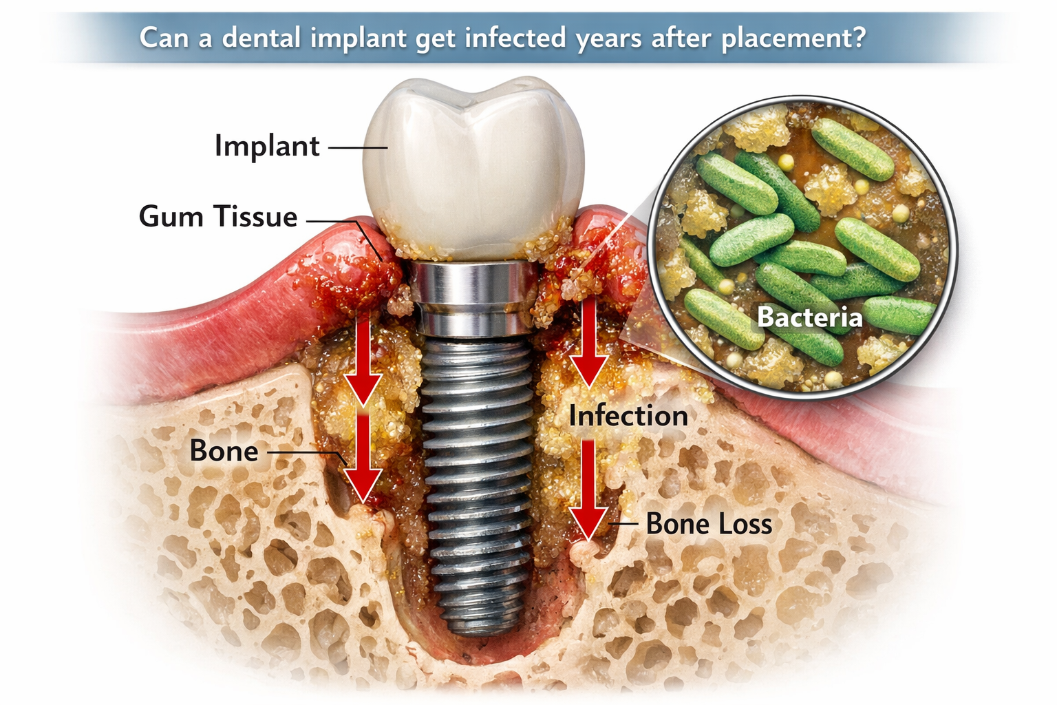 Can a Dental Implant Get Infected Years After Placement? A Comprehensive Guide for 2026